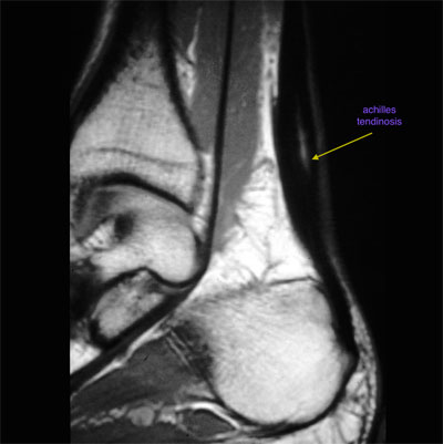 Achilles Tendonitis