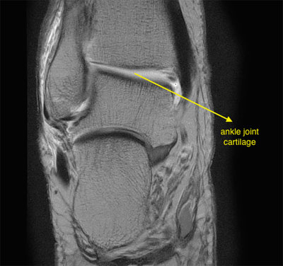 Ankle Arthritis