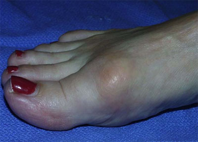 Big toe arthritis - Hallux Rigidus