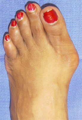 Bunions - Hallux Valgus