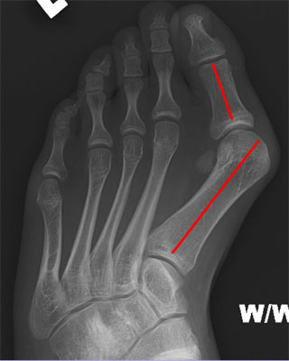 Bunions - Hallux Valgus