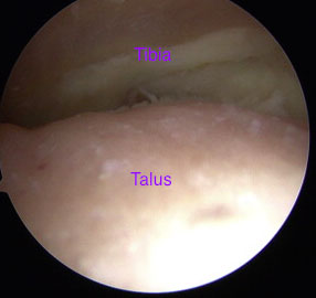 Ankle Arthroscopy