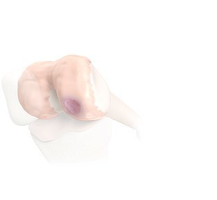 Bioploy implants