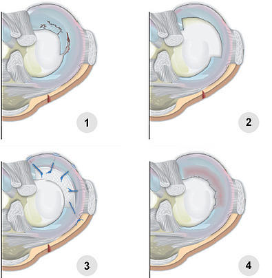 Meniscal Transplant Surgery